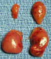 parathyroid adenoma picture