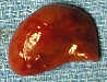 parathyroid adenoma picture