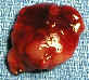 photo of large parathyroid tumor