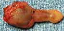 parathyroid tumor photo