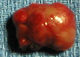 parathyroid tumor photo