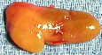 parathyroid tumor photo