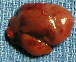 parathyroid gland photo