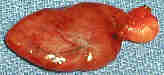 parathyroid gland adenoma photo