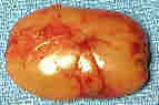 parathyroid gland adenoma photo