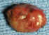 parathyroid gland adenoma photo