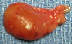 parathyroid gland adenoma photo