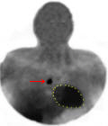 Parathyroid adenoma in the chest of a patient with parathyroid disease.