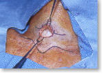Small 1 inch incision for MIRP mini-parathyroid surgery for parathyroid disease.