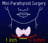 MIRP parathyroid surgery has a small incision instead of the big incision in standard parathyroid surgery.