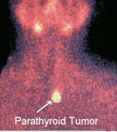 Sestamibi scan: High quality sestamibi scan shows a single parathyroid adenoma.