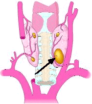 Sestamibi scan shows this parathyroid tumor. Sestamibi scan for hyperparathyroidism.