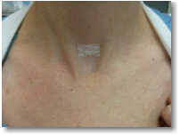 Parathyroid Surgery: Small scar from mini-parathyroid surgery.