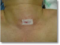 Mini parathyroid surgery with negative scan still has small scar.