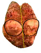Parathyroid cancer inside the right thyroid lobe.
